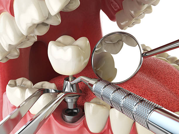 Best Emergency Dentist for Knocked-Out Tooth in Remlap, AL